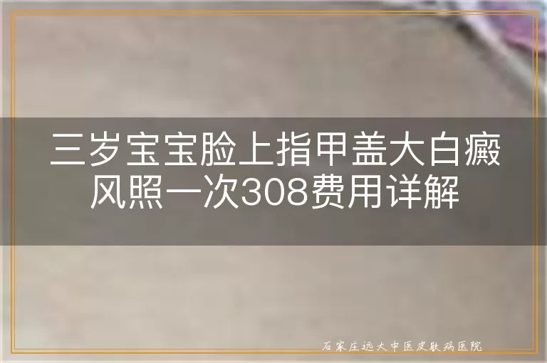 三岁宝宝脸上指甲盖大白癜风照一次308费用详解