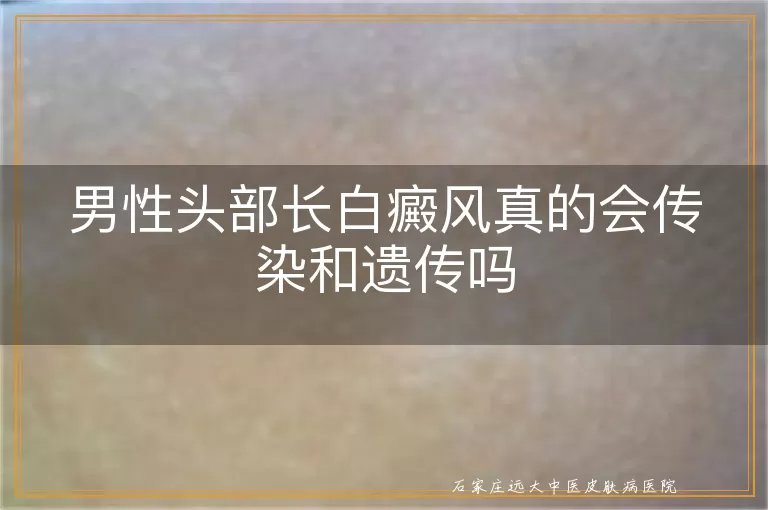 男性头部长白癜风真的会传染和遗传吗