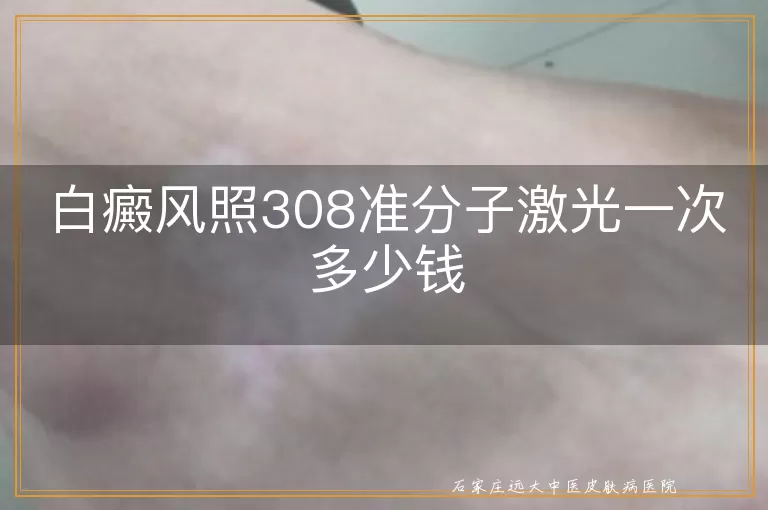 白癜风照308准分子激光一次多少钱