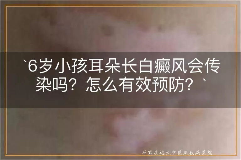 6岁小孩耳朵长白癜风会传染吗？怎么有效预防？