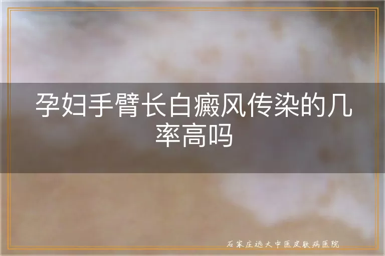 孕妇手臂长白癜风传染的几率高吗