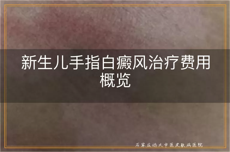 新生儿手指白癜风治疗费用概览