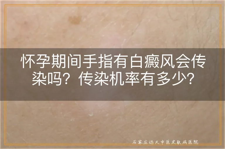 怀孕期间手指有白癜风会传染吗？传染机率有多少？