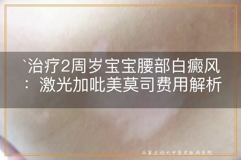 治疗2周岁宝宝腰部白癜风：激光加吡美莫司费用解析