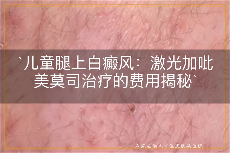 儿童腿上白癜风：激光加吡美莫司治疗的费用揭秘