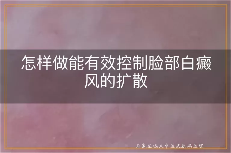 怎样做能有效控制脸部白癜风的扩散