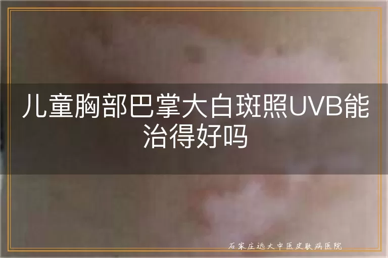 儿童胸部巴掌大白斑照UVB能治得好吗