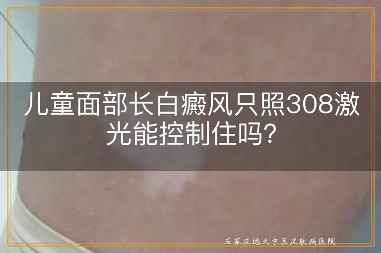 儿童面部长白癜风只照308激光能控制住吗？