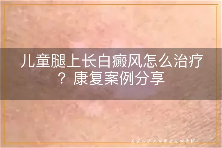 儿童腿上长白癜风怎么治疗？康复案例分享