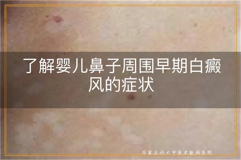 了解婴儿鼻子周围早期白癜风的症状