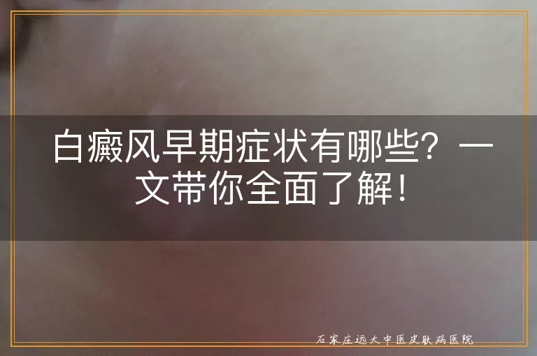 白癜风早期症状有哪些？一文带你全面了解！