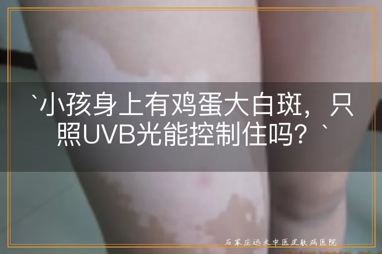 小孩身上有鸡蛋大白斑，只照UVB光能控制住吗？