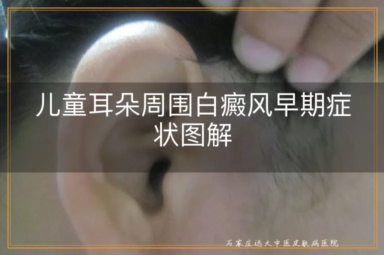 儿童耳朵周围白癜风早期症状图解