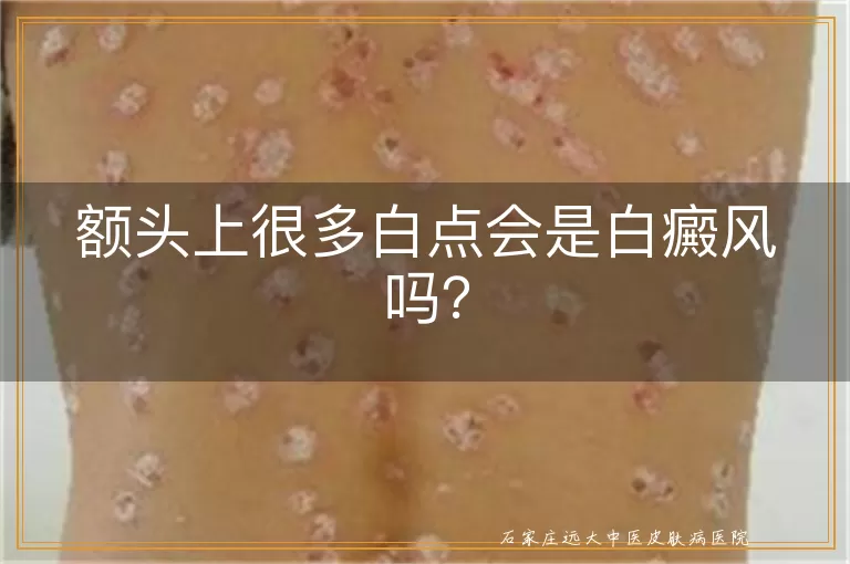 额头上很多白点会是白癜风吗？