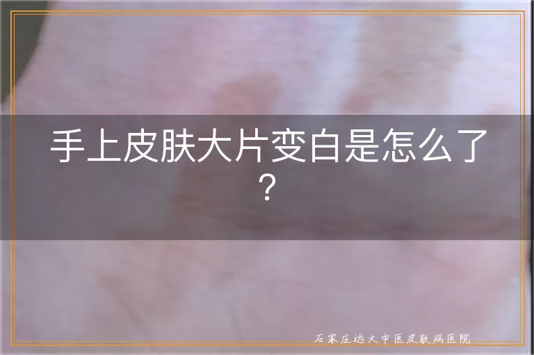 手上皮肤大片变白是怎么了？