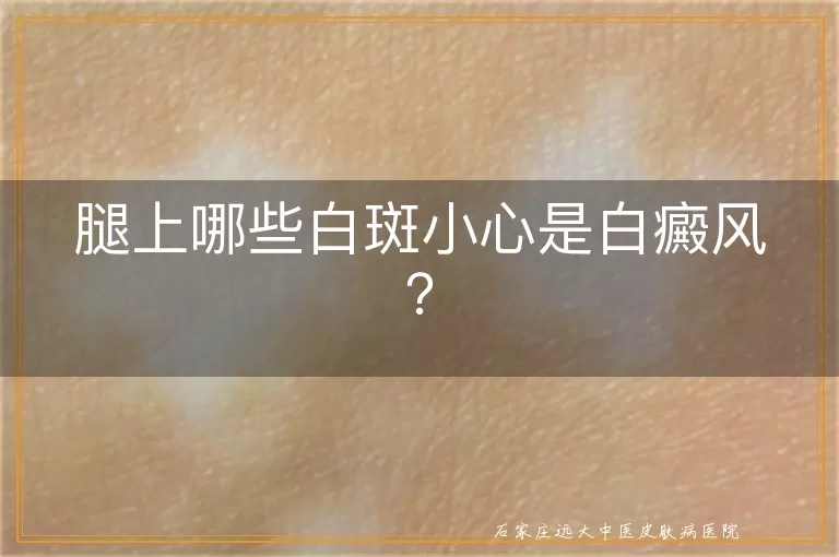 腿上哪些白斑小心是白癜风？