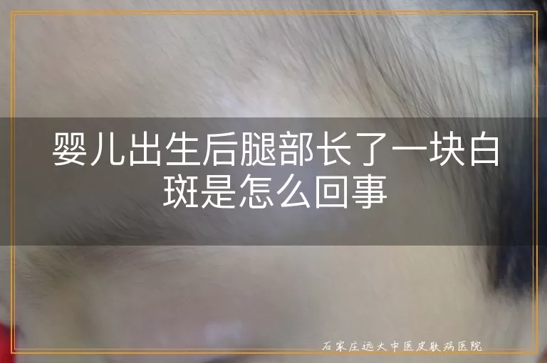 婴儿出生后腿部长了一块白斑是怎么回事