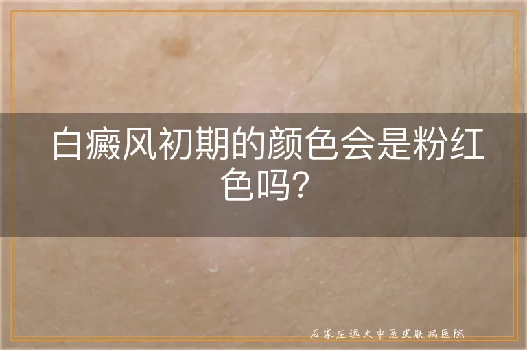 白癜风初期的颜色会是粉红色吗？