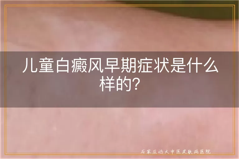 儿童白癜风早期症状是什么样的？