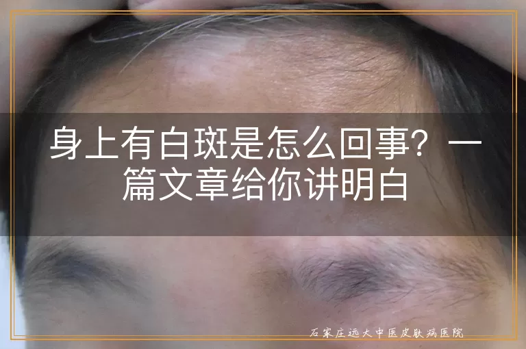 身上有白斑是怎么回事？一篇文章给你讲明白