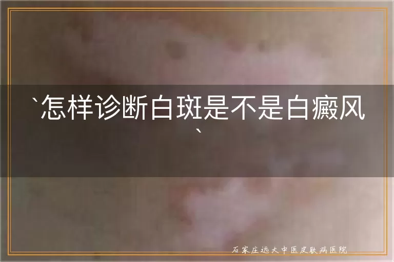 怎样诊断白斑是不是白癜风