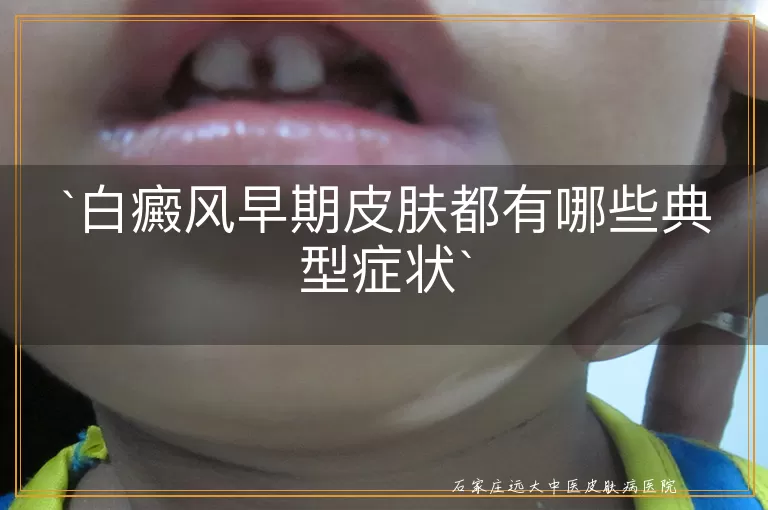 白癜风早期皮肤都有哪些典型症状