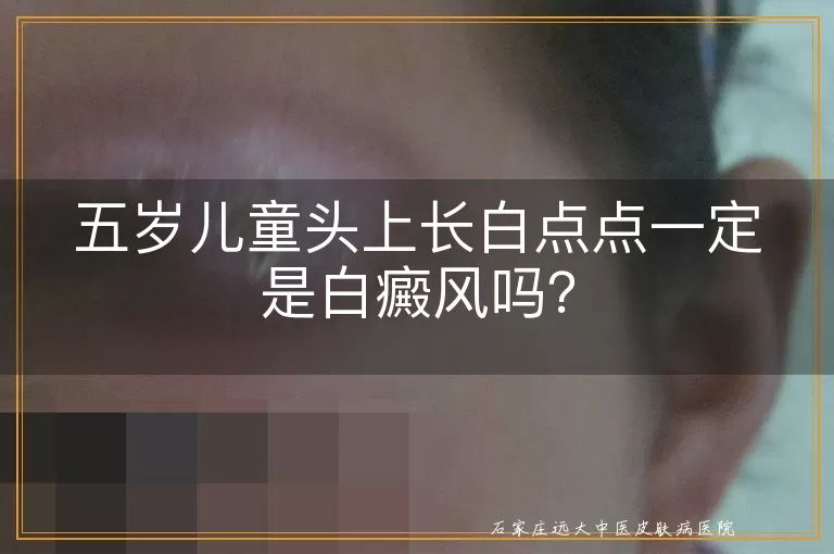 五岁儿童头上长白点点一定是白癜风吗？