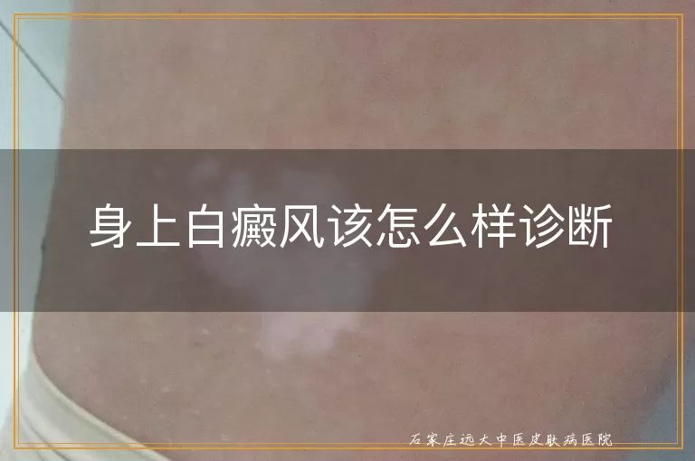 身上白癜风该怎么样诊断