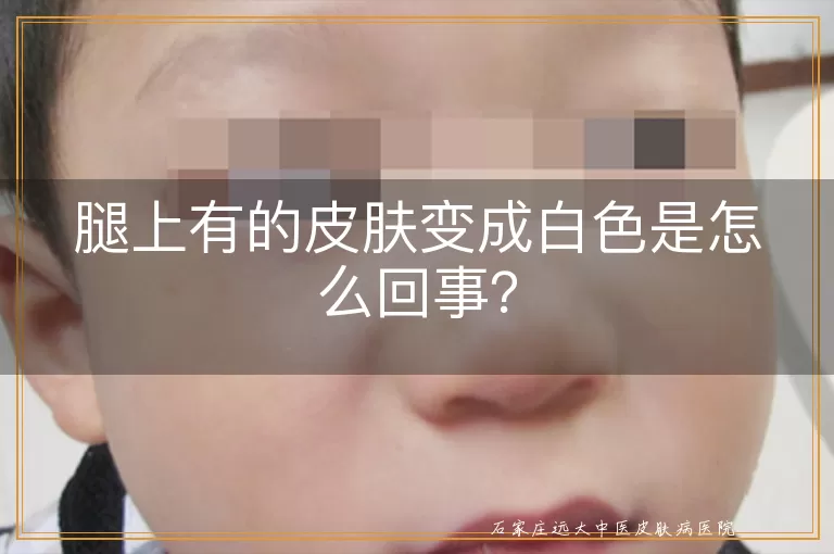 腿上有的皮肤变成白色是怎么回事？