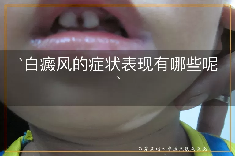 白癜风的症状表现有哪些呢