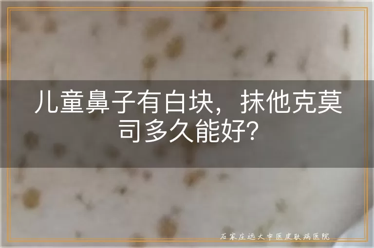 儿童鼻子有白块，抹他克莫司多久能好？