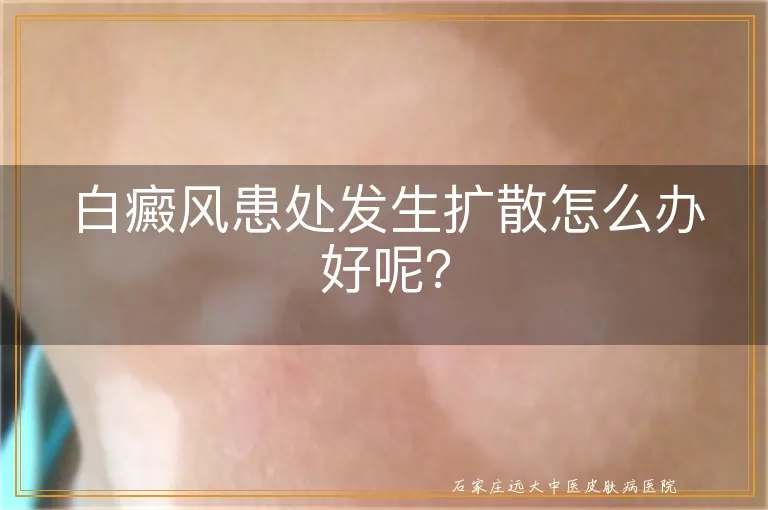 白癜风患处发生扩散怎么办好呢？