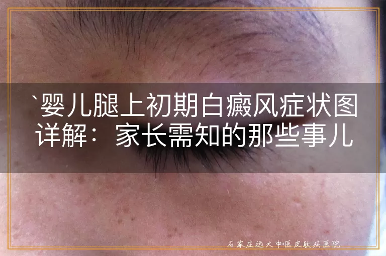 婴儿腿上初期白癜风症状图详解：家长需知的那些事儿