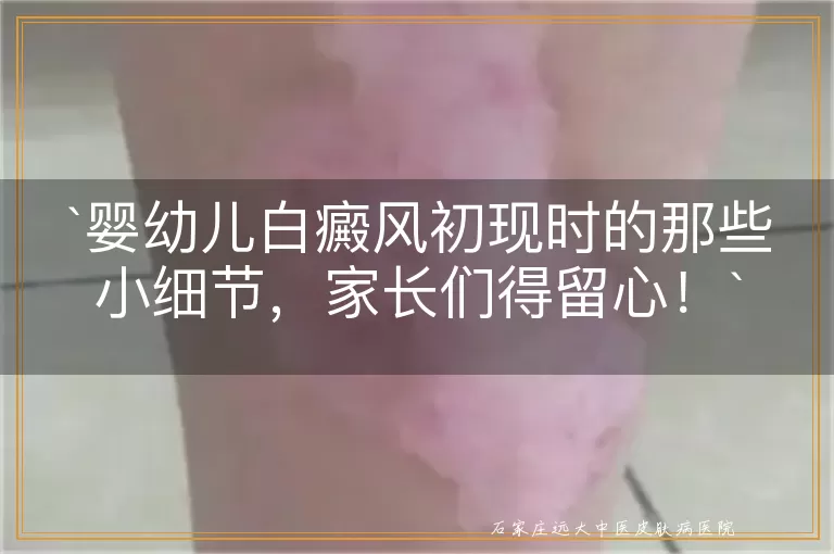 婴幼儿白癜风初现时的那些小细节，家长们得留心！