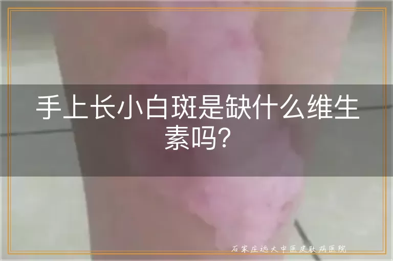 手上长小白斑是缺什么维生素吗？