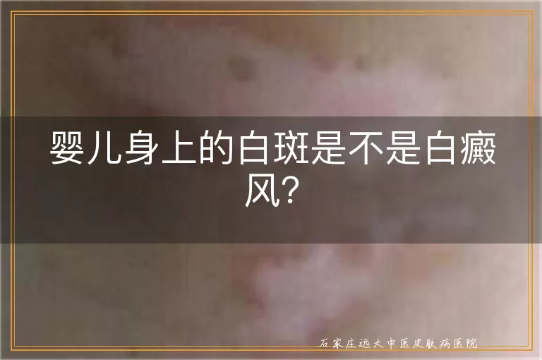 婴儿身上的白斑是不是白癜风？