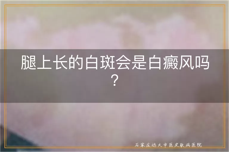 腿上长的白斑会是白癜风吗？