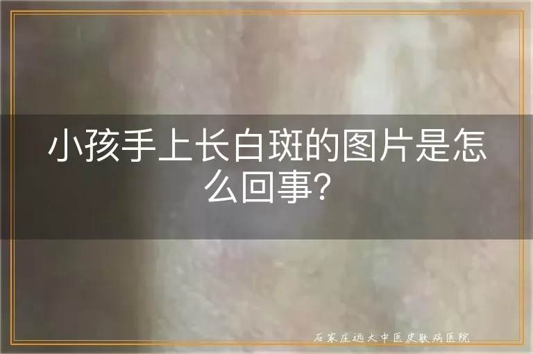 小孩手上长白斑的图片是怎么回事？