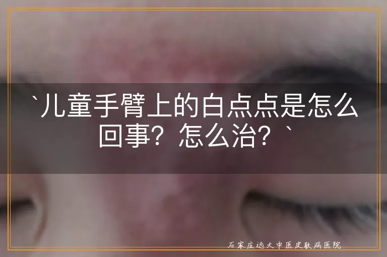 儿童手臂上的白点点是怎么回事？怎么治？