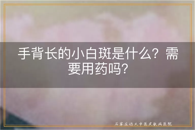 手背长的小白斑是什么？需要用药吗？