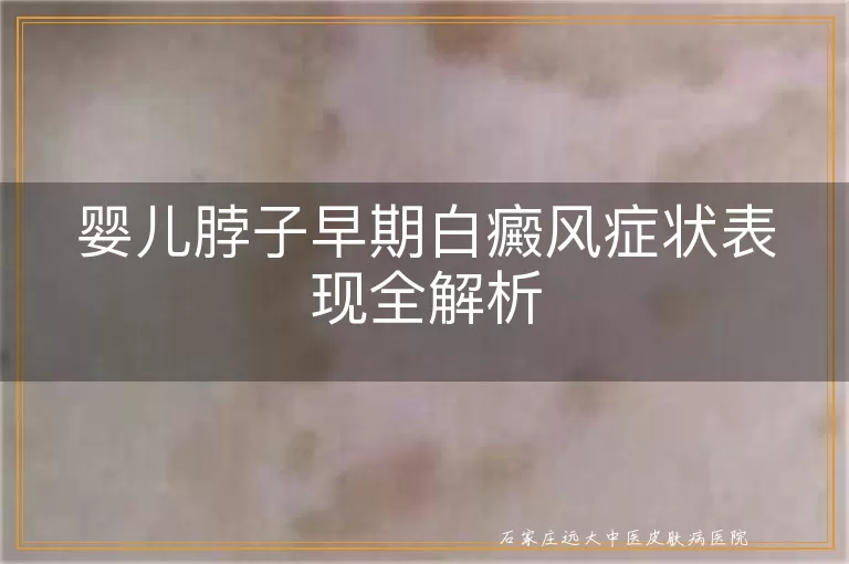 婴儿脖子早期白癜风症状表现全解析