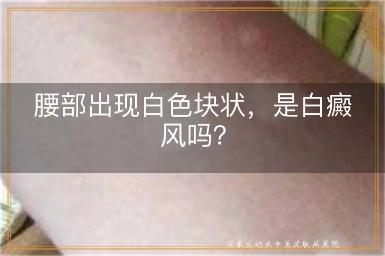 腰部出现白色块状，是白癜风吗？