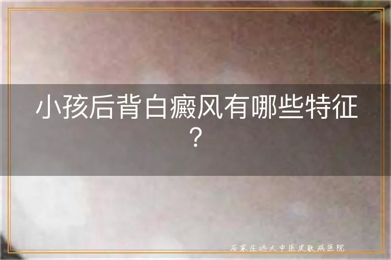 小孩后背白癜风有哪些特征？