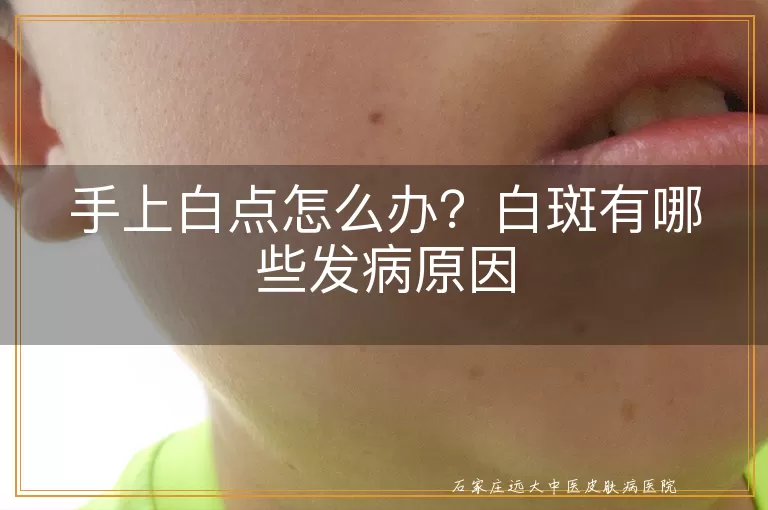 手上白点怎么办？白斑有哪些发病原因