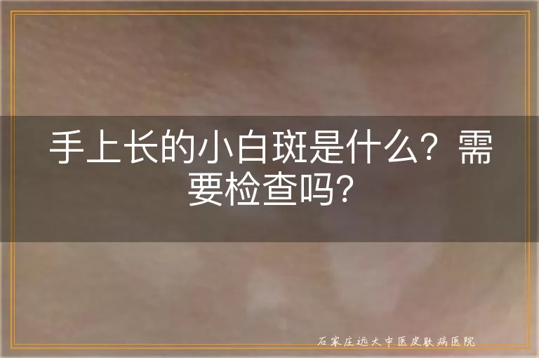 手上长的小白斑是什么？需要检查吗？