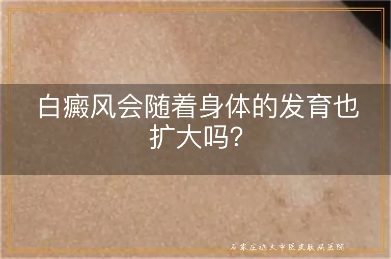 白癜风会随着身体的发育也扩大吗？