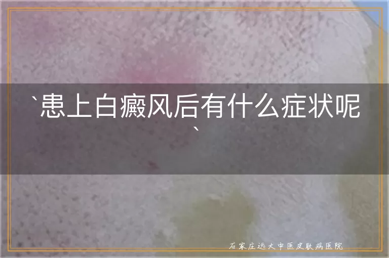 患上白癜风后有什么症状呢