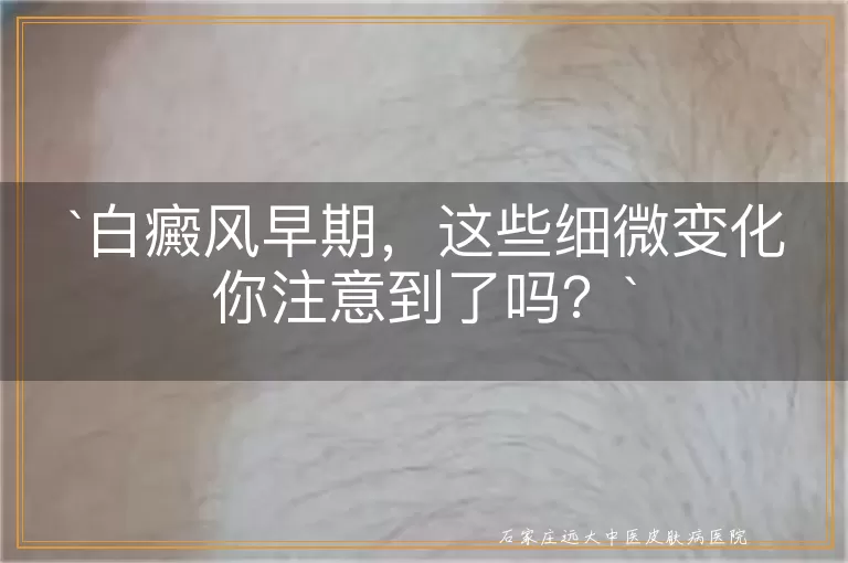 白癜风早期，这些细微变化你注意到了吗？