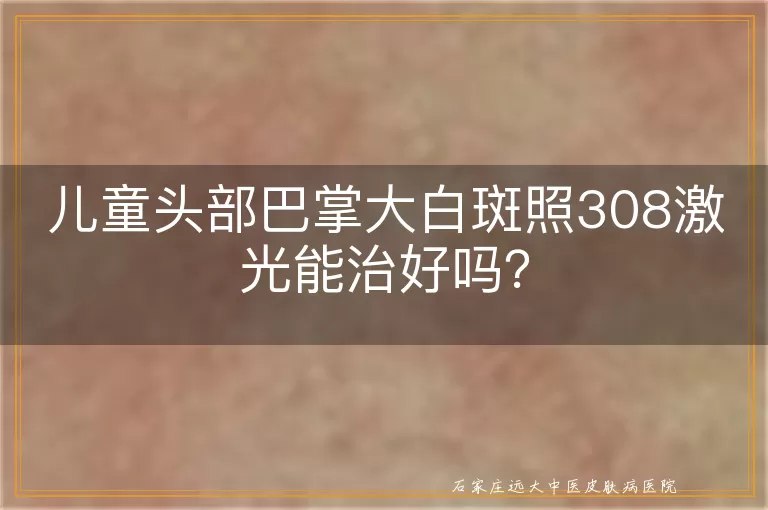 儿童头部巴掌大白斑照308激光能治好吗？