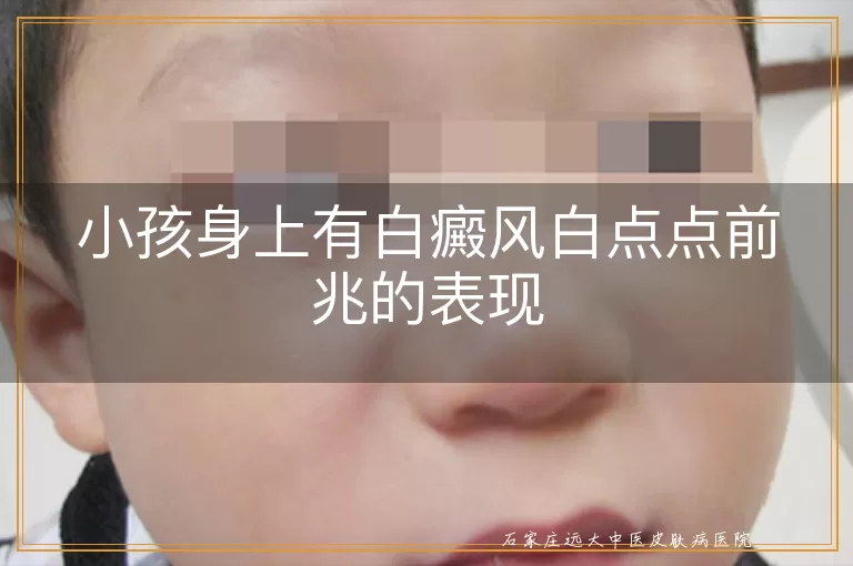 小孩身上有白癜风白点点前兆的表现